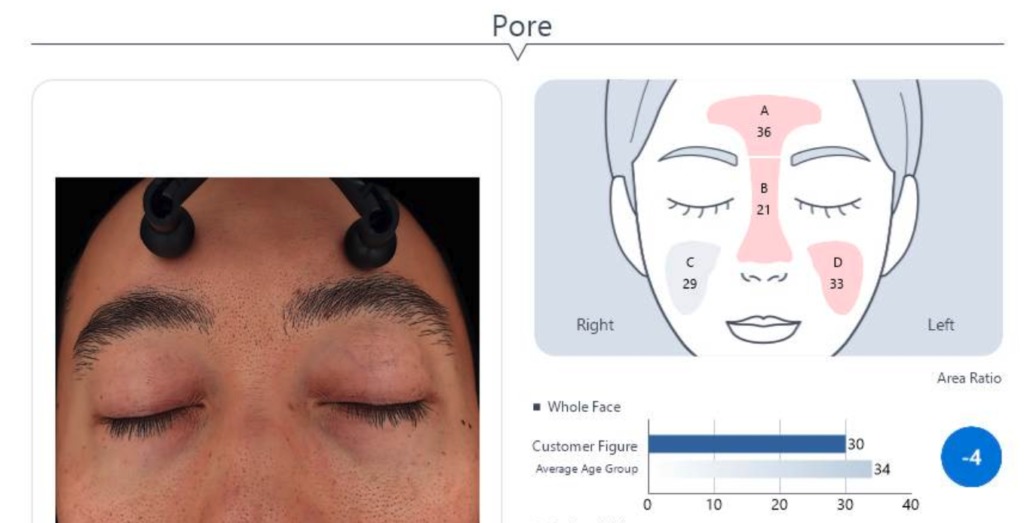 Visual report from an advanced facial scan highlighting areas of dryness, wrinkles, and pores